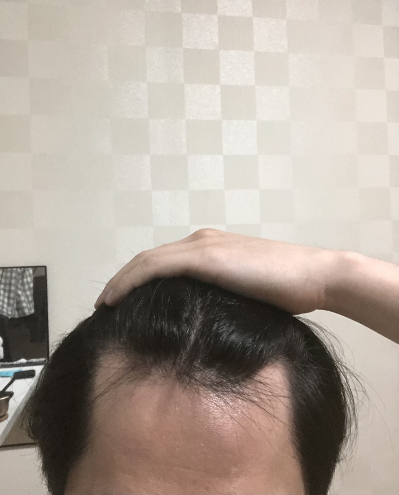 2200 毛非切开双块手术后