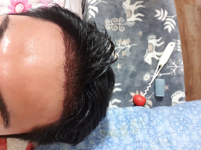 이식수술 1일차