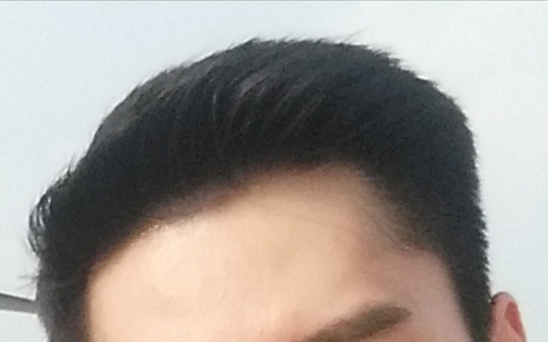 Got about 1000 follicle transplant by non-excision from the parent star (at 8 months).