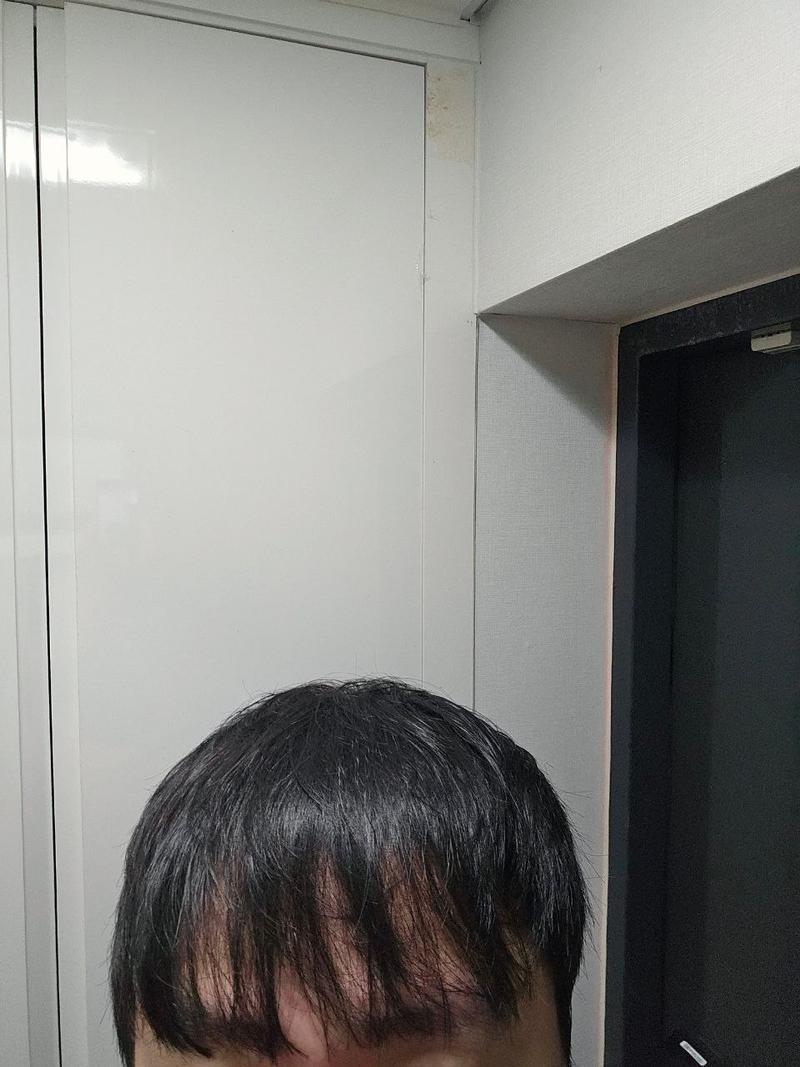 【母材性整形外科】移植後500日後のレビュー