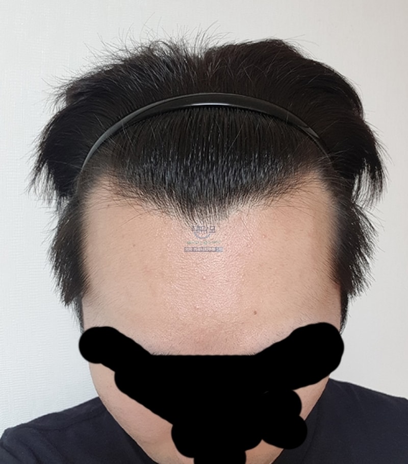 非切开2100毛，两周后记。 淘汰开始了ㅠ