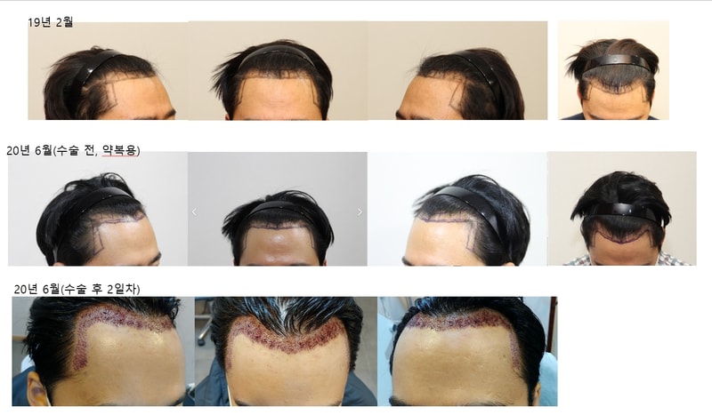 New Hair医院毛发移植1500毛囊非切开第3天后期