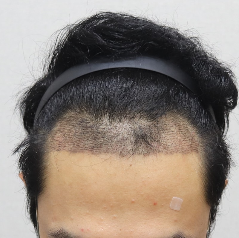 2주 후 정면.JPG