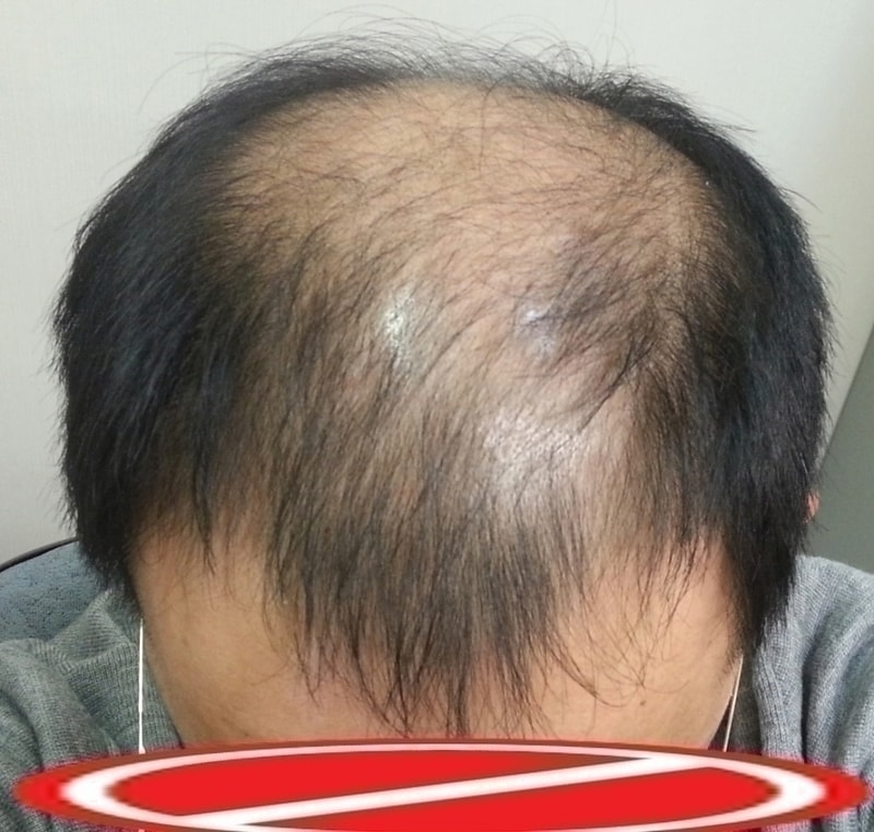 이식전_위쪽_1.jpg