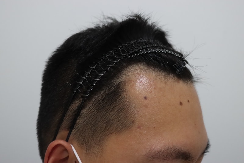 I got a hair transplant. I'm relieved