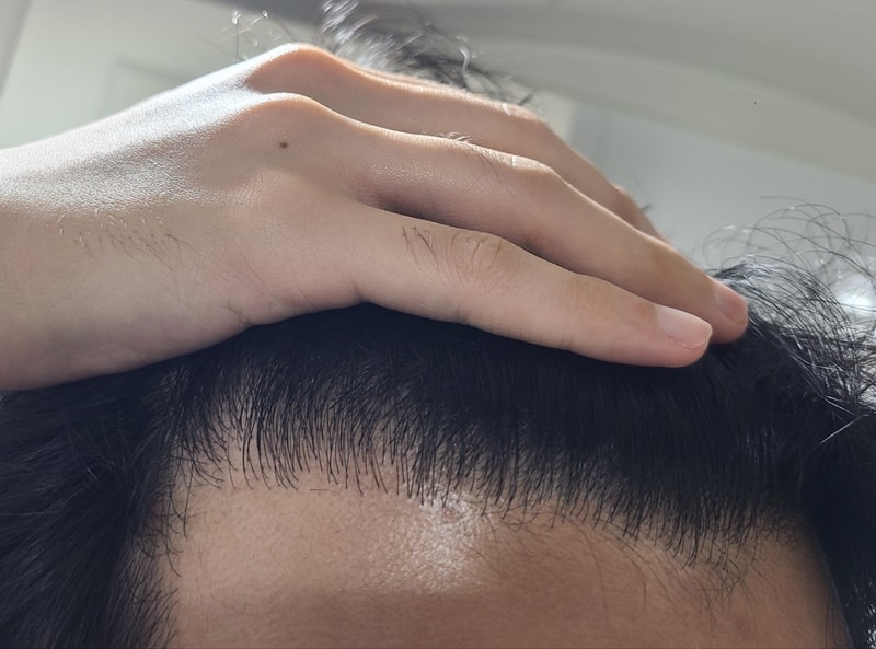 Top of the head + M shape / incision + non-excision mix. I'm posting a review of the first year