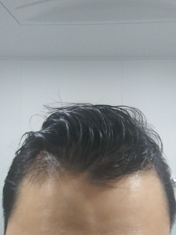 머리이식.jpg