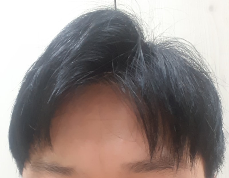 1년7개월 좌측.jpg