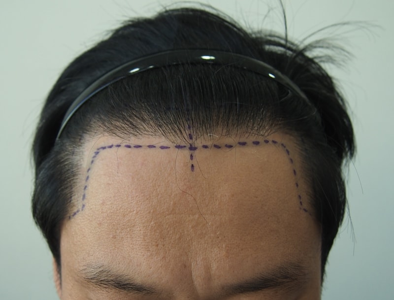 1 year evaluation of hair follicles of 1900, density check 2 weeks ago