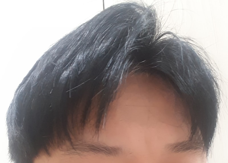 1년7개월 우측.jpg