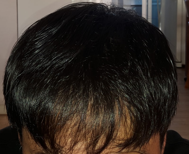 수술전 앞머리 갈라짐.jpg