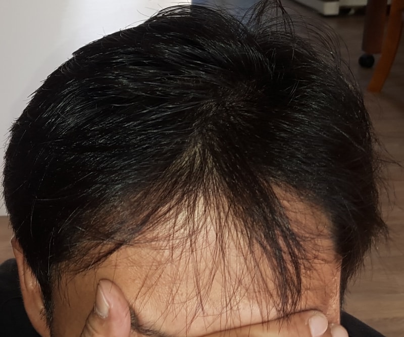모재성 이식전 앞머리.jpg