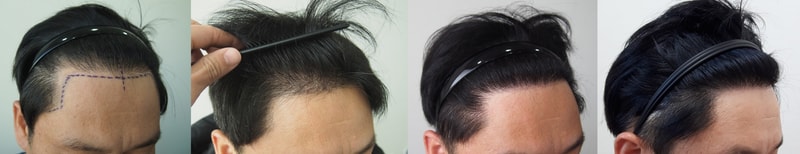 수술1년차 우측 이어붙이기.jpg