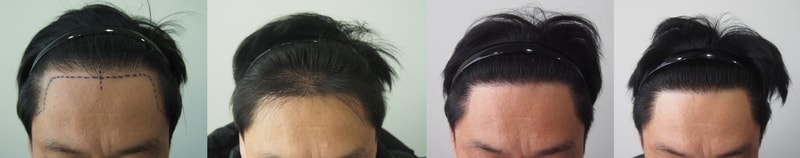 수술1년차 정면 이어붙이기.jpg