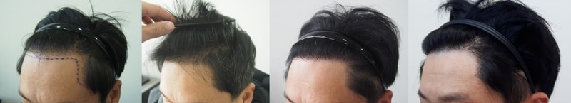 수술1년차 좌측 이어붙이기.jpg