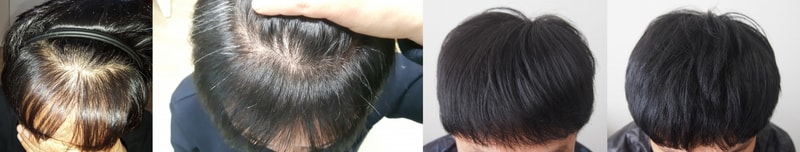 수술 1년차 밀도보강 이어붙이기.jpg
