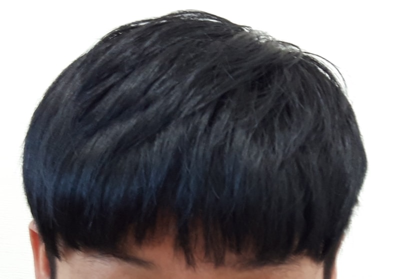 Parental 1,900 hair follicles with one-year evaluation density reinforced, scar transplantation