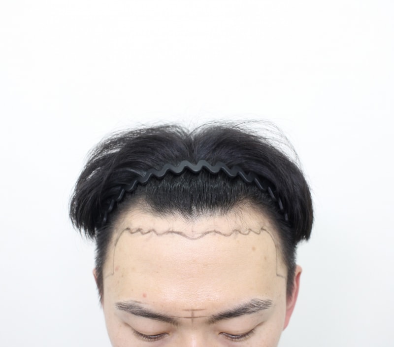 신사역,모프로의원,문건학원장님, 엠자 절개모발이식, 10일차