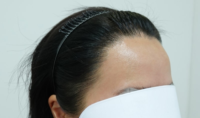[Growing up] 1655 Hairline Women's Hairline Non-cut 12 Months Review