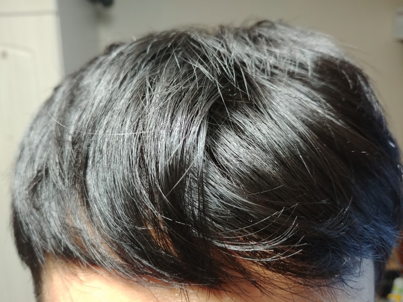 1300모낭 + @, 20대후반 비절개 일주일 수술후기