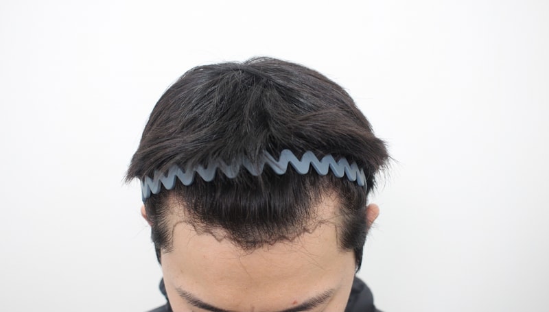 모프로의원 문건학 원장님, 신사역, 모발이식, 6개월차