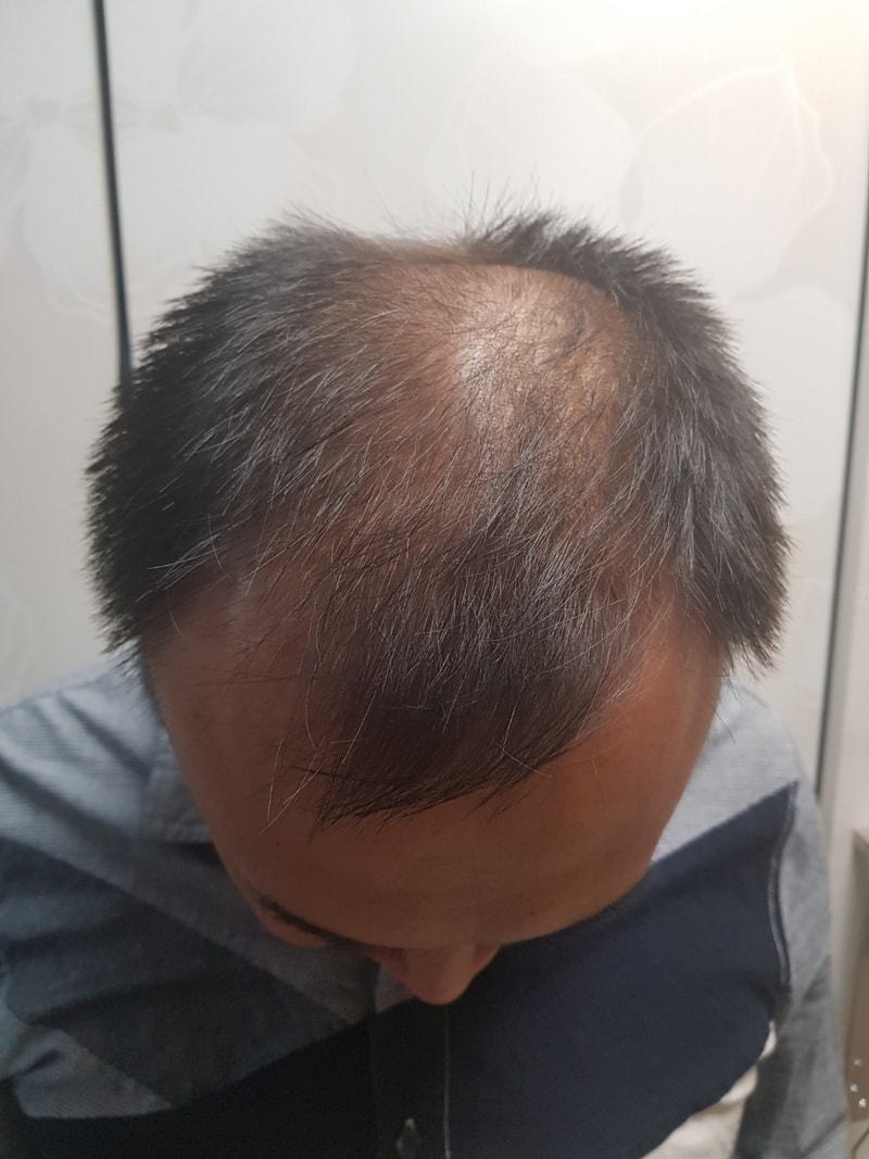 New Hair移植第1年后期