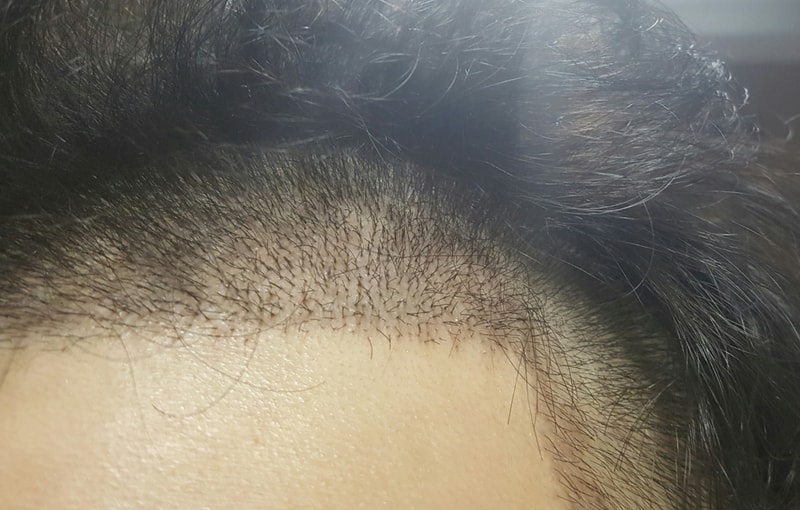 Pseudo-plastic non-cut 1700 hair follicle 12th day Please look at the density after removing the scab