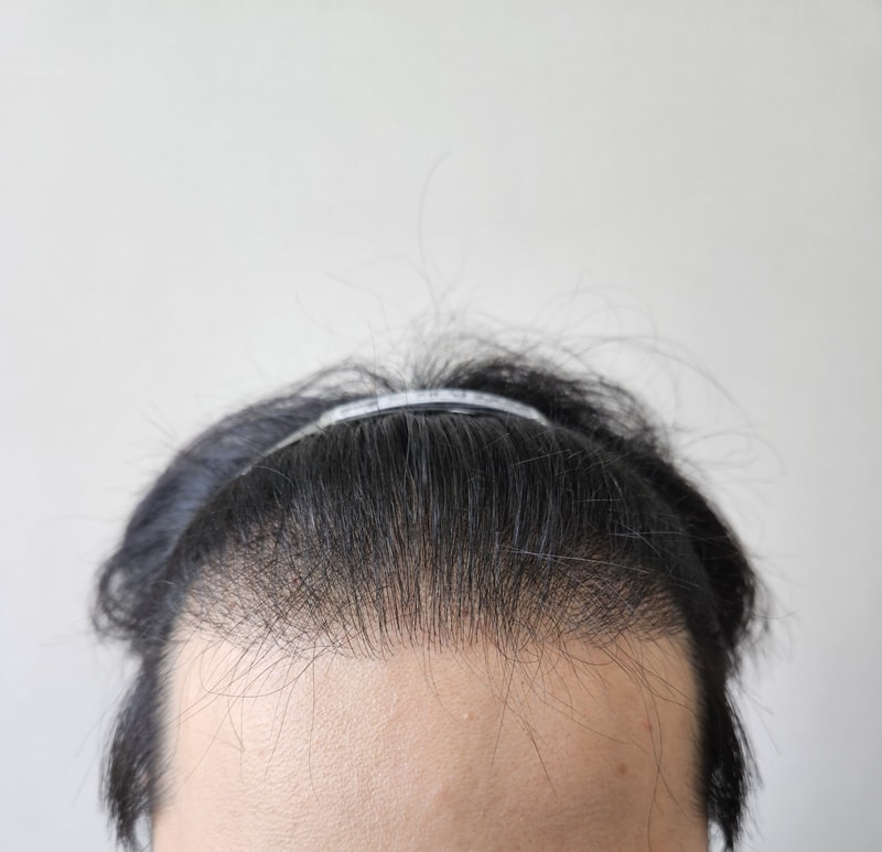 信じて任せる非切開手術後のレビュー