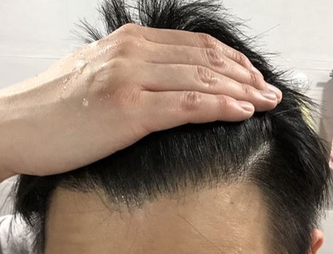 手術後1年7ヶ月目のレビューです。