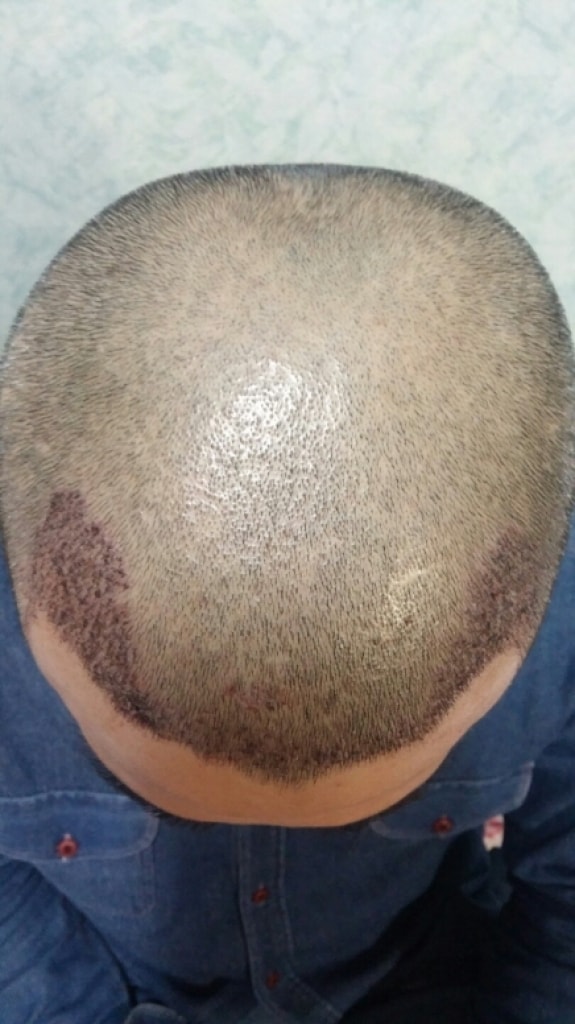 我在For Hair接受了cit手术。