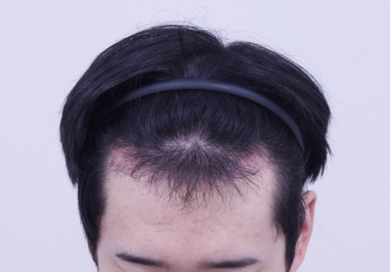 크기변환_수술후1개월.JPG