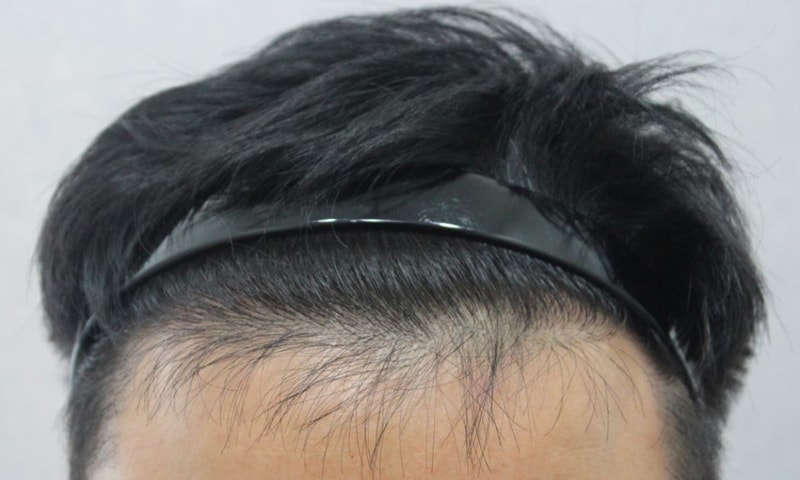 C2G Vibal 1800 Hair follicle evaluation for 9 months [Four Hair Daegu]