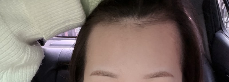 Rep. Apgujeong's review of the Hair Transplant.