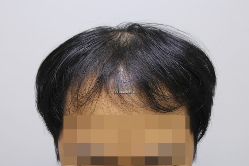 It's a three-month period of forehair.
