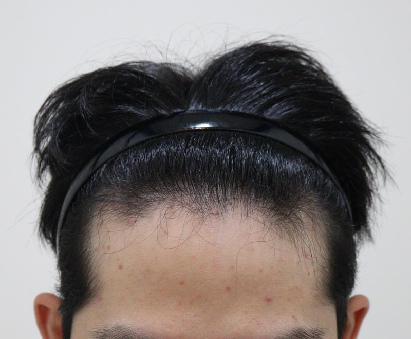 It's been 3 months since the hair transplant, but I'm so satisfied