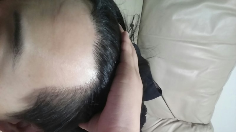 Motion) M-shaped and hairline 1200 hair follicles about 9 months late