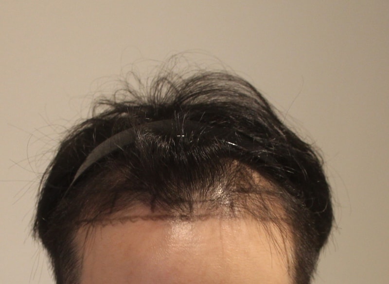 New Hair(江南)无剃头非切开毛发移植第3个月后期