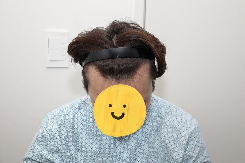 New Hair (Seoul) incisional hair transplant (M shape + Gouretnaru) 6 months old