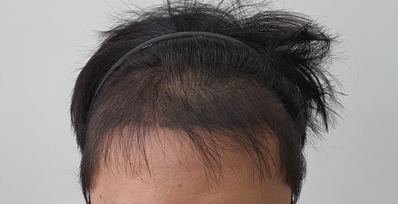Non-cut 2090 Hair follicle 120th day review