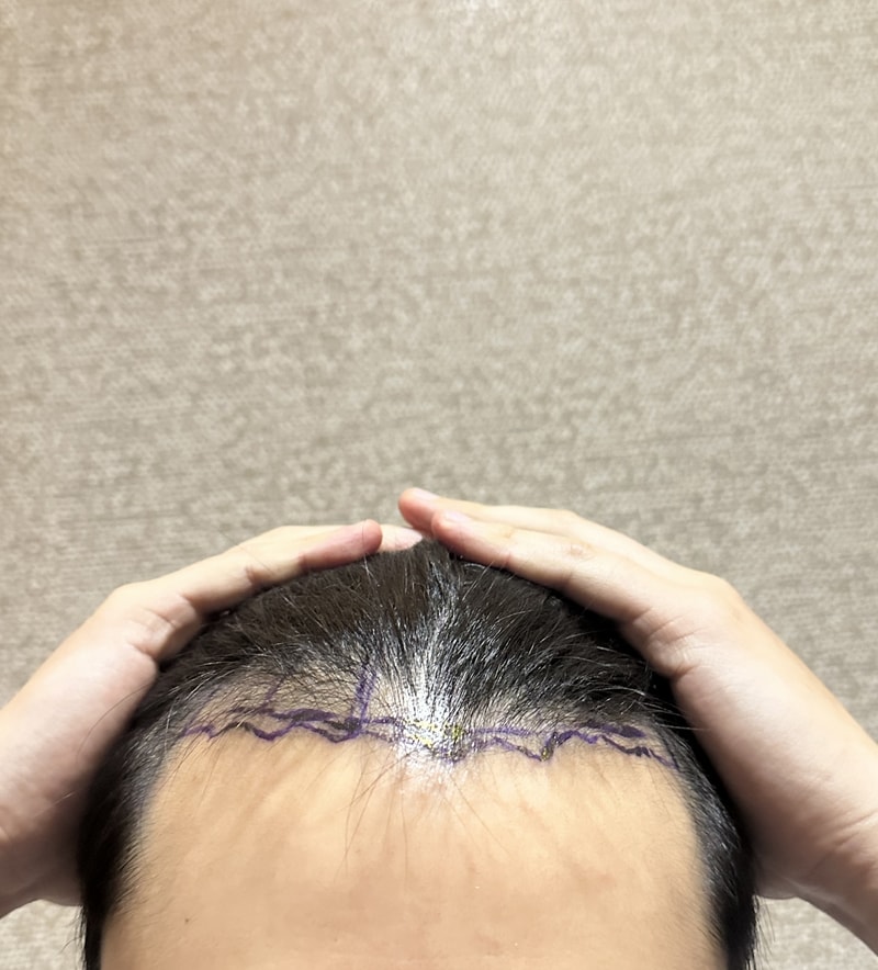 뉴헤어모발성형외과 모발이식 1700모낭 후기