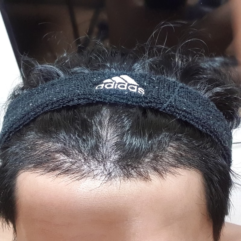 탈모 2주차 1.jpg