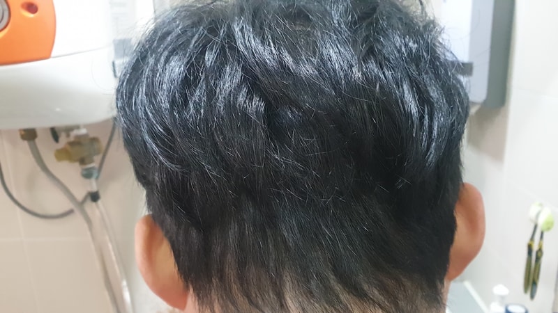 탈모 2주차후두부 1.jpg