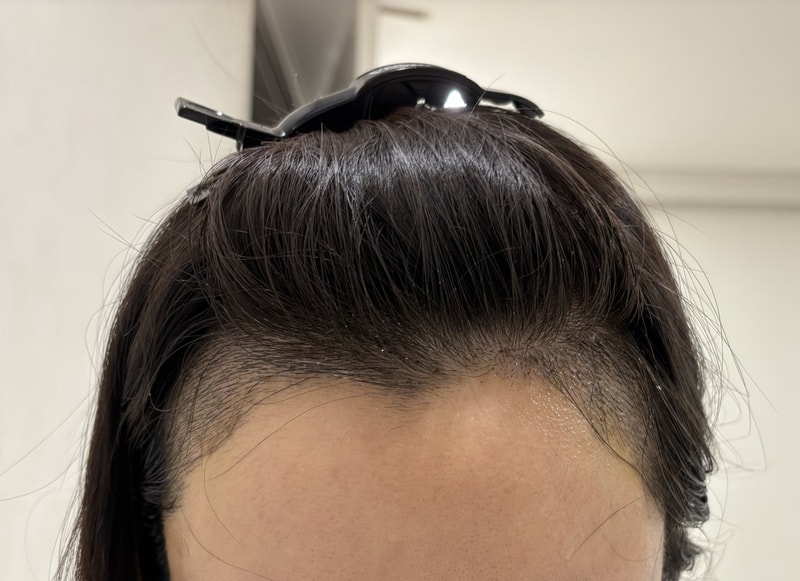 Rep. Mo Woo-rim of Apgujeong, a review of hairline transplantation on the first day