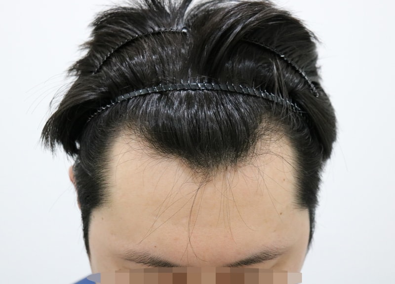 3000모 - 비절개 - 6개월 후기 남깁니다..