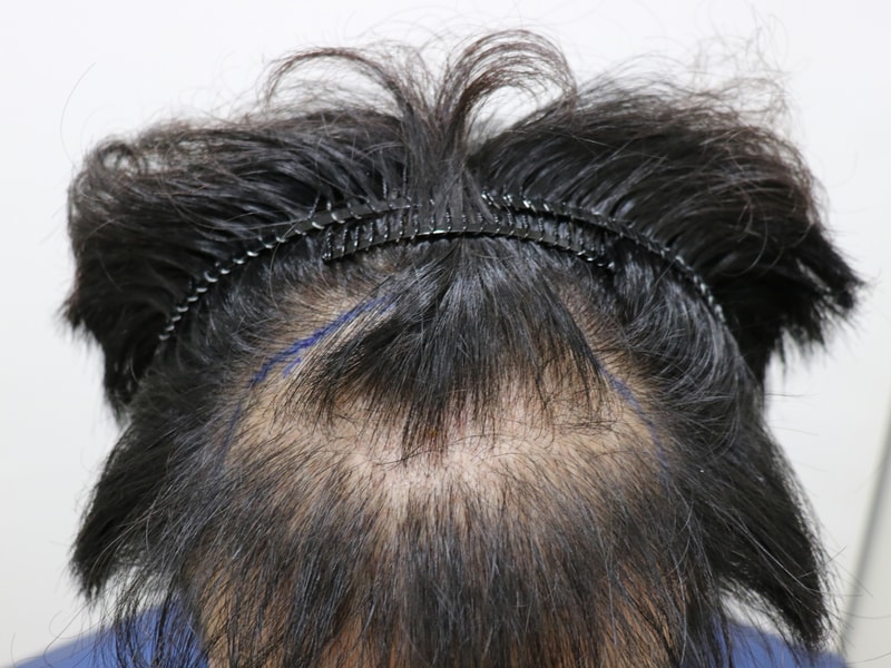 수술 전 3.jpg