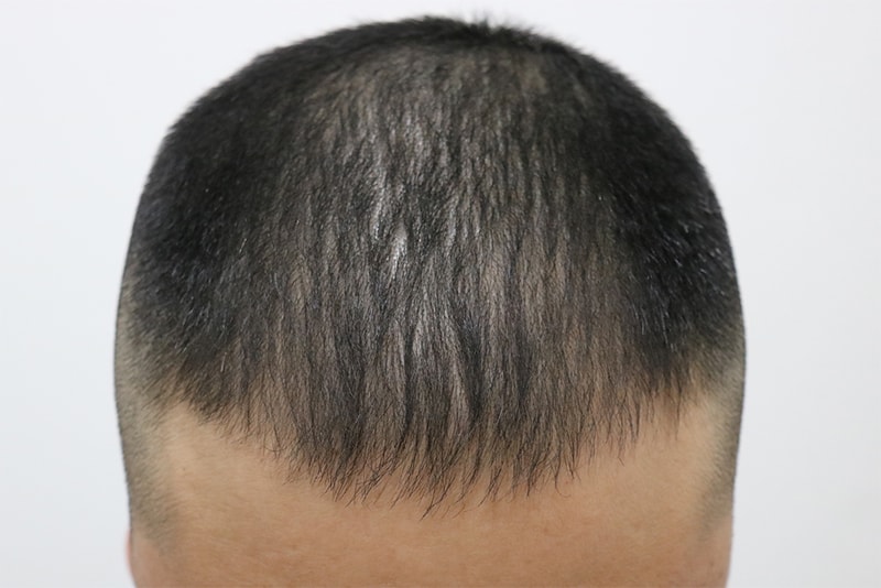 I'm posting the review of 4,000-mo surgery for non-cut hair transplantation.
