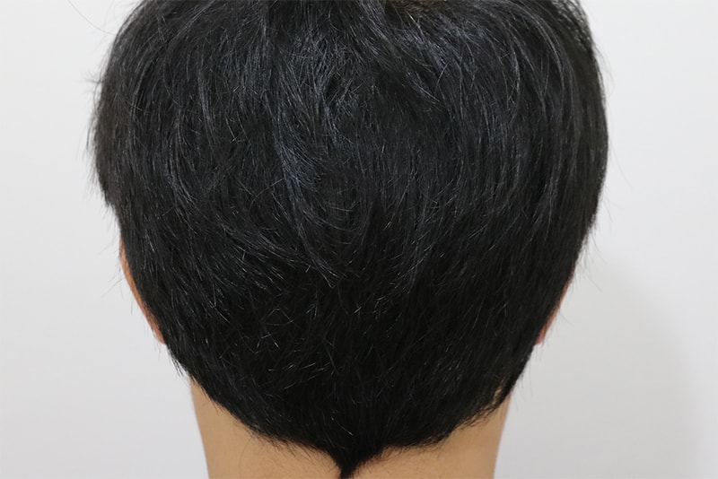 수술 후 뒷모습 1.jpg