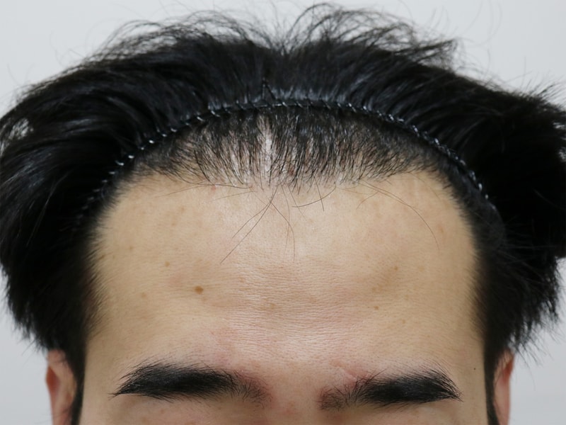 再手術を受けてから1年が経ちました..