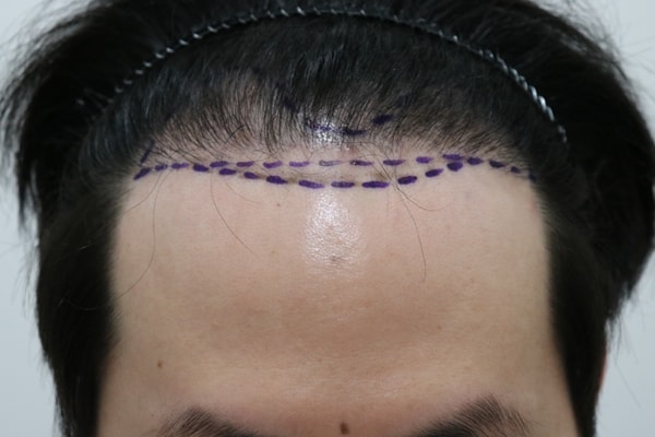 It's been two weeks since the hair transplant..