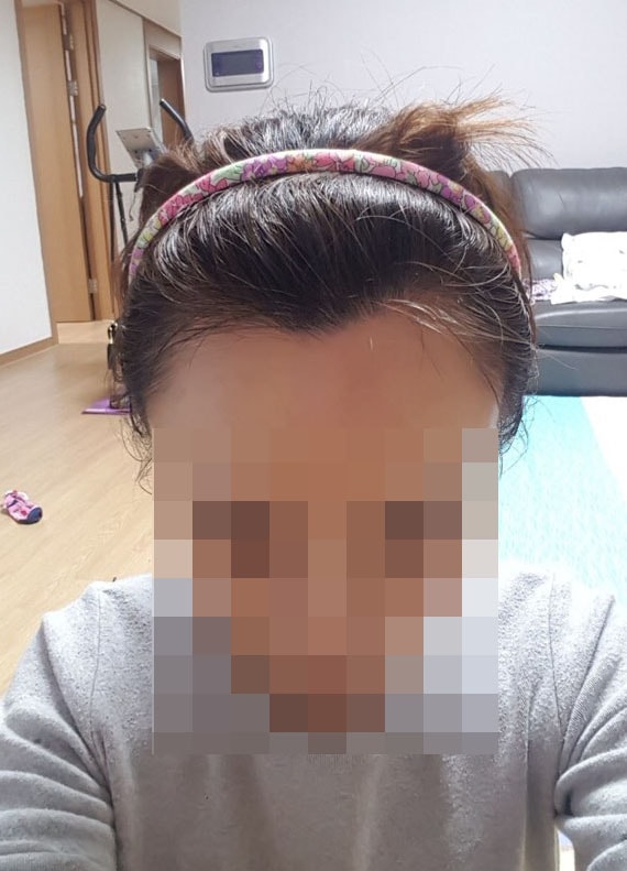 비절개 2500모 수술 후기(컴플렉스 떨치니 기분이 날아갈것 같네요)